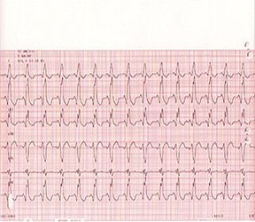 Electrocardiography (ECG) and Holter/Event Monitors